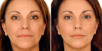 Botox, Injectables, at a fraction of the cost in Canada