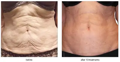 ✨ Venus Freeze Skin Tightening – Non-Invasive Face & Body ✨, View more