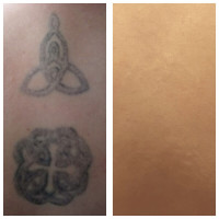 $113.00 for Laser Tattoo Removal!