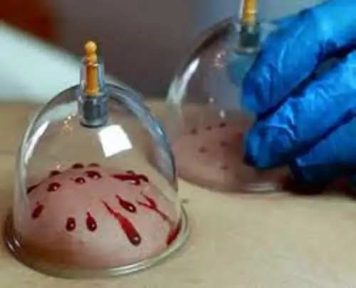 Hijama in Markham536176024324689925
