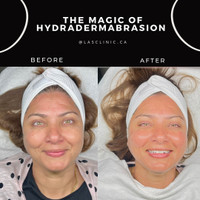 Hydrafacial/HydraDermabrasion DELUX Facial!! 