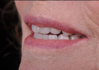 Smile with confidence + EASTHETIC DENTURES 