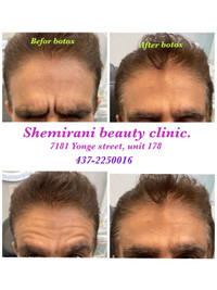 Botox for wrinkle reduction 