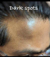 Solution for Dark Spots and Pigmentation 