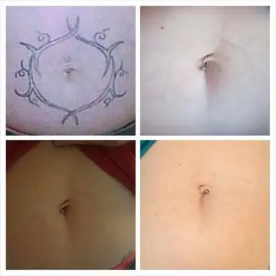 PicoSure Tattoo Removal, View more