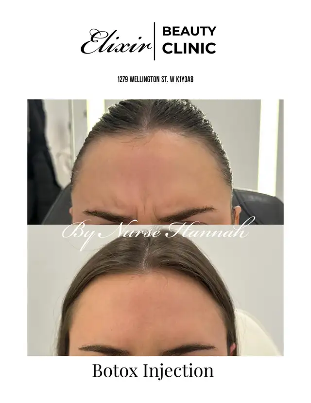 Thermage, Sciton BBL, Potenza, Hydrafacial, Botox, HA Filler62864742287619122