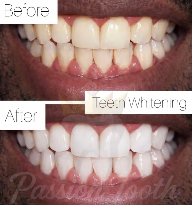 $99 Teeth Whitening65076500382210120