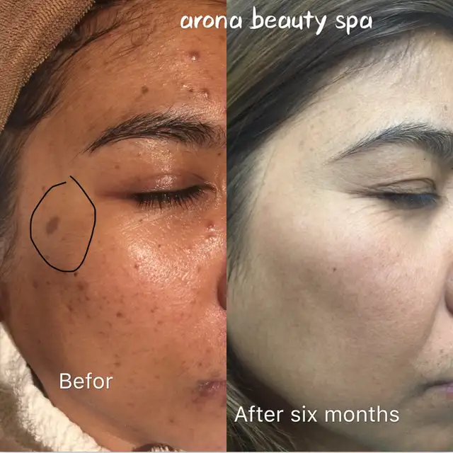Skin tags removal 50% off in Health and Beauty Services in City of Toronto - Image 6