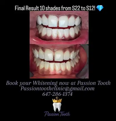 $99 Promo Teeth Whitening by a Registered Dental Hygienist, View more