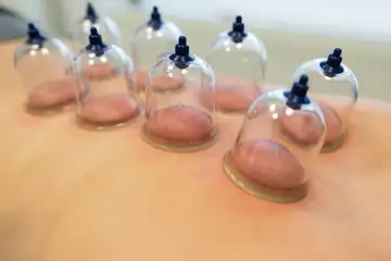 Hijama in Markham536176024324689921