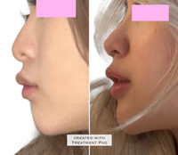 Liquid Rhinoplasty (non-surgical nose job) & Chin Filler