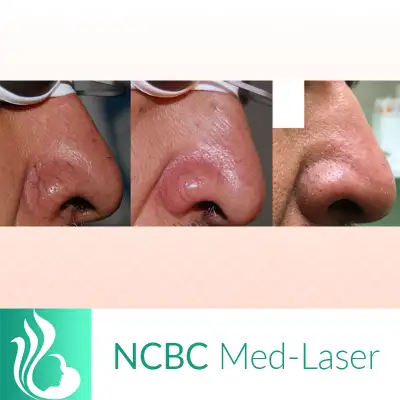 Mole/Skin tag / Scar/ Birthmark  removal -50% off in Massage Services in City of Toronto - Image 6