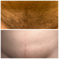 LASER HAIR REMOVAL clinic - 40%OFF