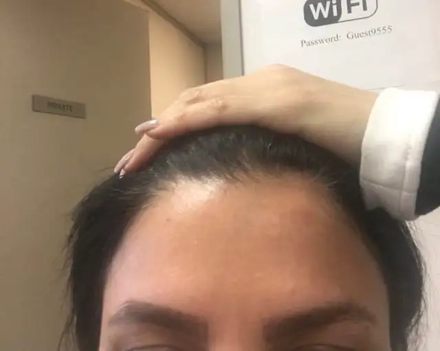 PROMOTION FOR BOTOX 4.5$ per unit Filler 270$ MOBILE SERVICE GTA63235385774849124
