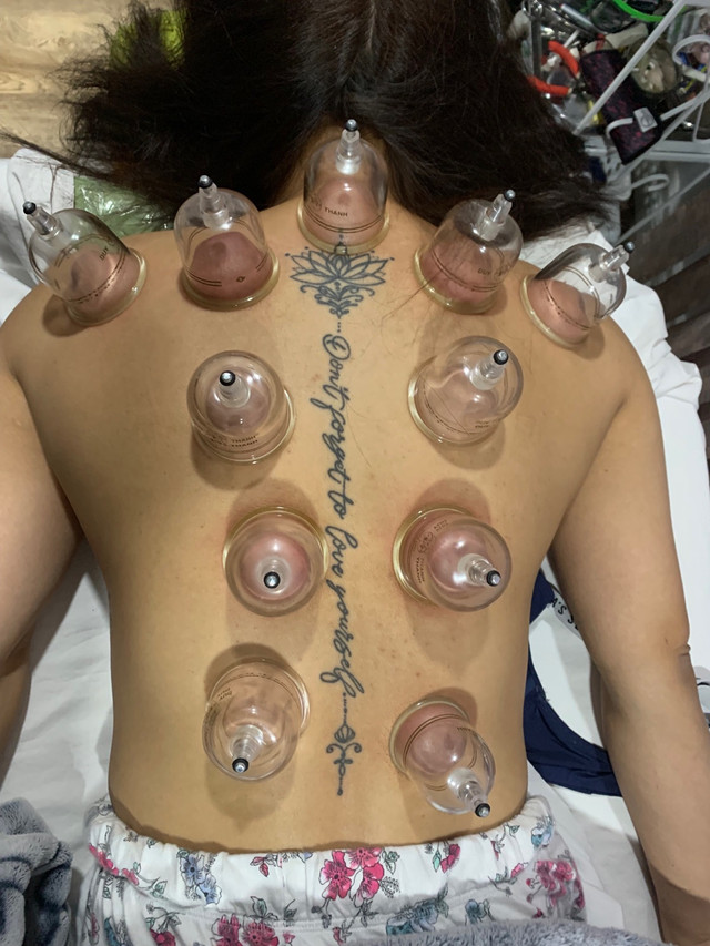 CUPPING  in Other in Edmonton - Image 2
