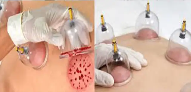 Hijama in Markham536176024324689923