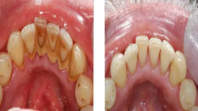Dental Cleaning 