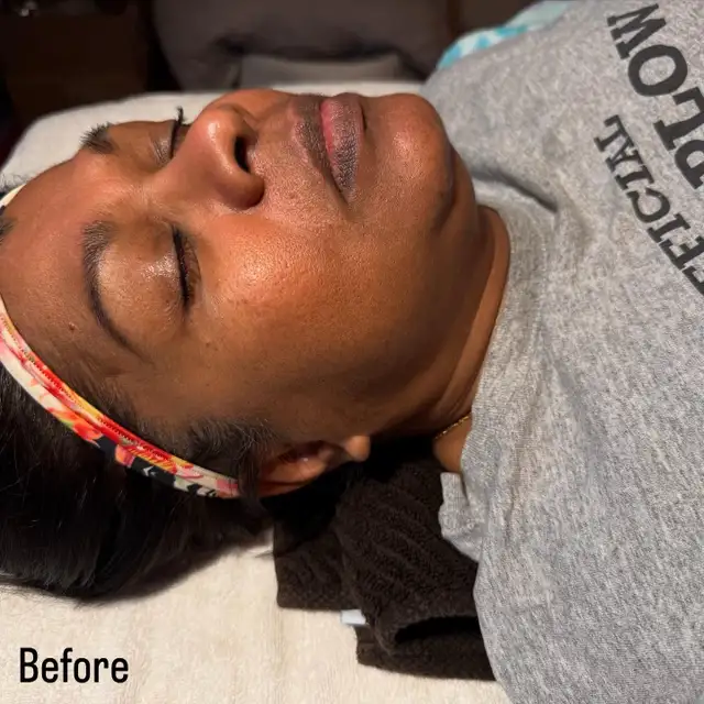 Dermaplane Facials - GTA - Mobile Esthetician62863244454786123