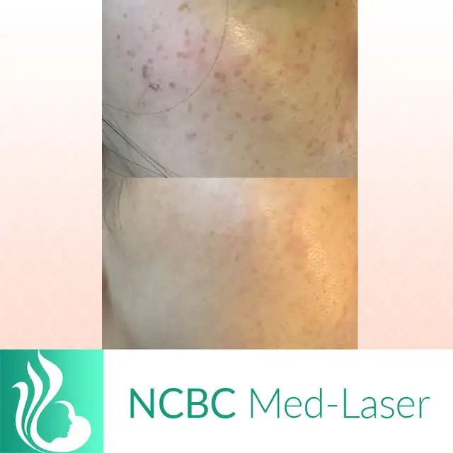 Mole/Skin tag / Scar/ Birthmark  removal -50% off in Massage Services in City of Toronto - Image 7