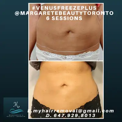 Tighten Loose Skin PainFREE> For ALL, View more