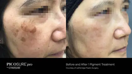 Thermage, Sciton BBL, Potenza, Hydrafacial, Botox, HA Filler62864742287619124