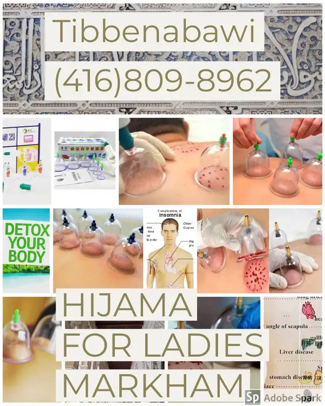 Hijama in Markham536176024324689922
