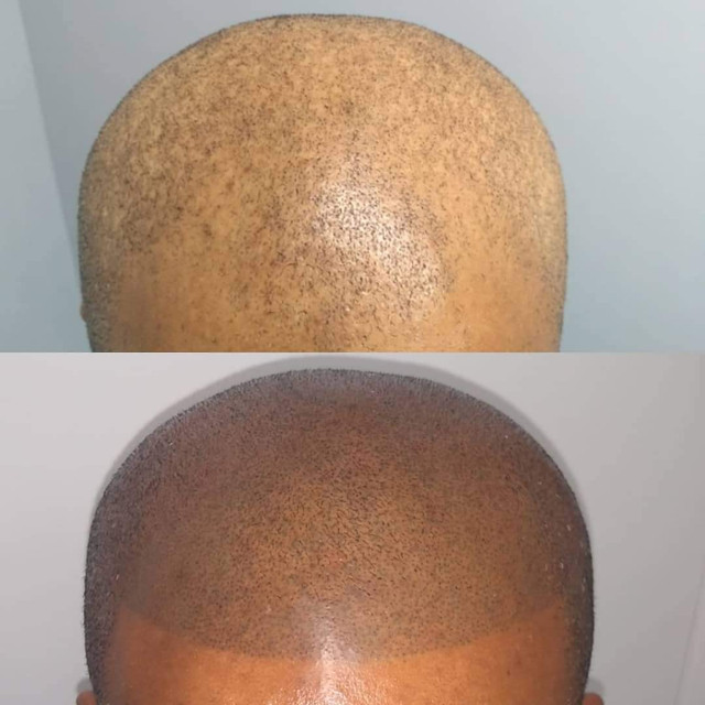 ⭐ Scalp Micropigmentation - Design & Treatment - Call Today ⭐ in Health and Beauty Services in Oshawa / Durham Region - Image 3