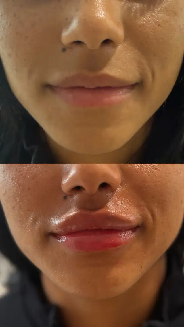 Botox filler - PRP - fat dissolving - skin booster63234910750977122