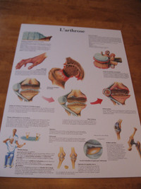 Affiches sur l'arthrose en plastique épais (3 exemplaires)