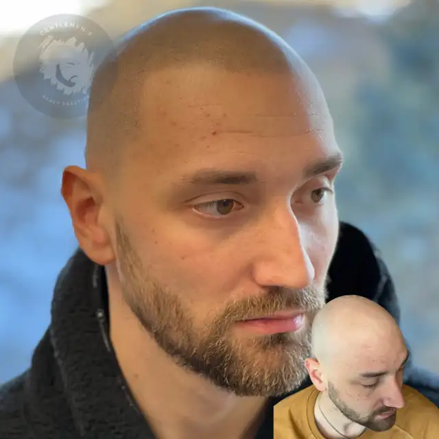 Scalp Micropigmentation | SMP | Hair & Scalp Tattoo | Hairline62863238047234121