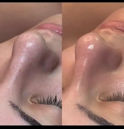 hydra facial and micro needling for u, View more