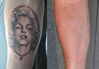 Tattoo Removal for $100 + HST