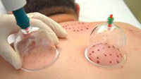 Hijama in Markham (Ladies only)