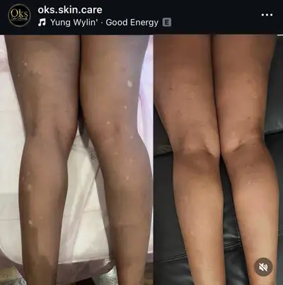 Revitalize your skin with our medical camouflage tattoo services, designed to expertly conceal scars...