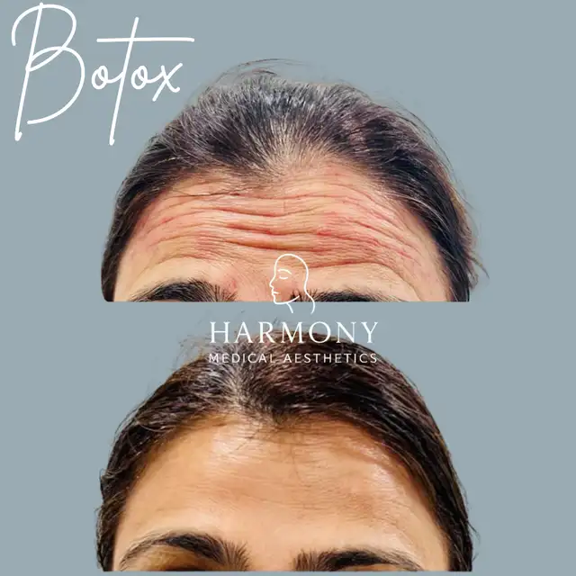 AUGUST PROMO BOTOX $6/UNIT & MICRONEEDLING $10063373390726403121