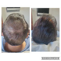 Prp hair treatment 