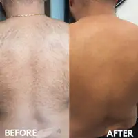 Men’s laser hair removal! Only $120