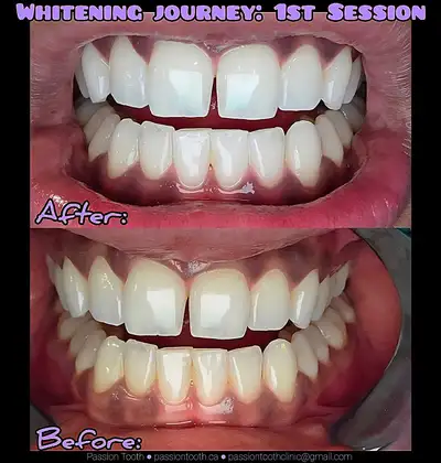 $99 Teeth Whitening  by A Licensed Dental Hygienist , View more