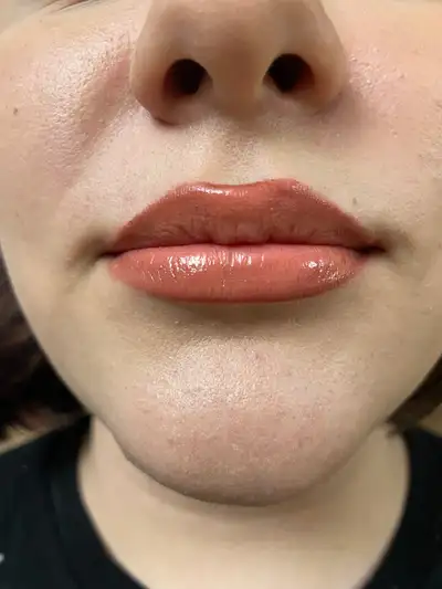 PROMOTION  BOTOX 4.5$ p unit/ 250$ Filler Syringe /mobile servic, View more