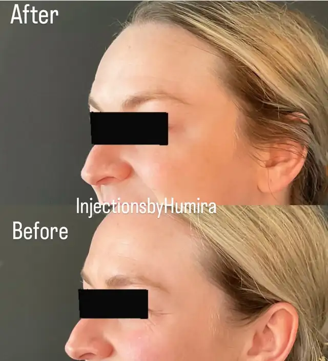 Botox- filler 64519987427713121