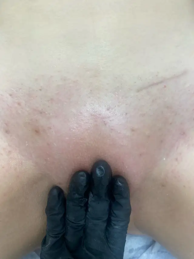 Brazilian wax