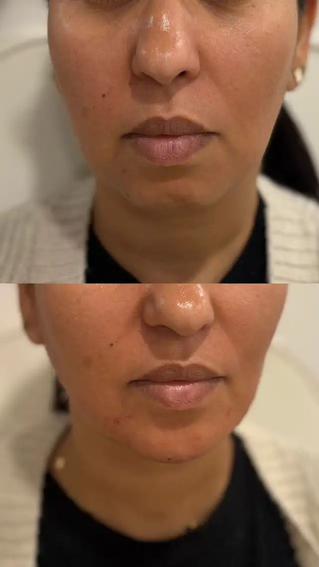 Botox filler - PRP - fat dissolving - skin booster63234910750977123