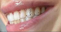 Tooth gems 