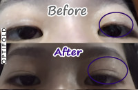 Are you Asian with a single eyelid? Want double eyelids free?