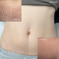 Stretch Mark Removal (PERMANENT RESULTS)