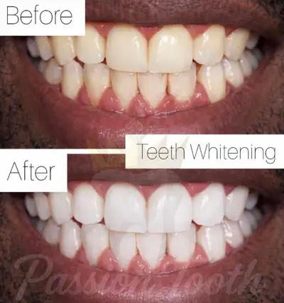 Yellow teeth? Whiten it for $99 by a licensed dental hygienist , View more