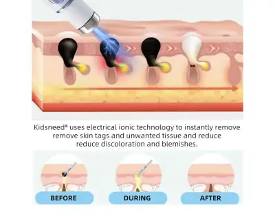 Removal Laser Pen, View more
