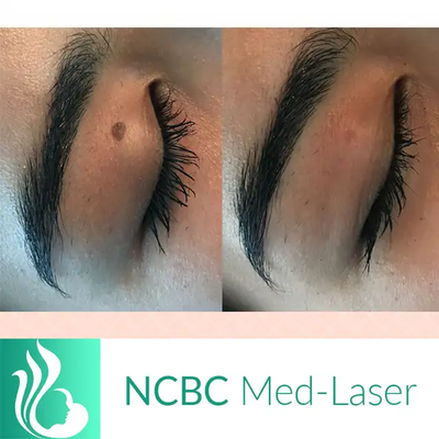 Mole/Skin tag / Scar/ Birthmark  removal -50% off, View more