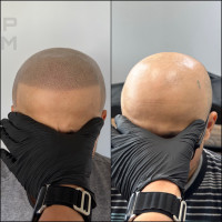 SMP scalp micro pigmentation 
