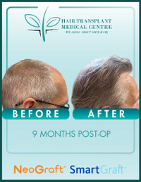 BEST PRICED PRP & HAIR/BEARD TRANSPLANT SERVICES AVAILABLE